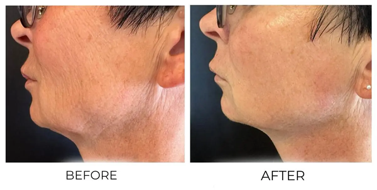 T-Shape Facial Face & Neck result