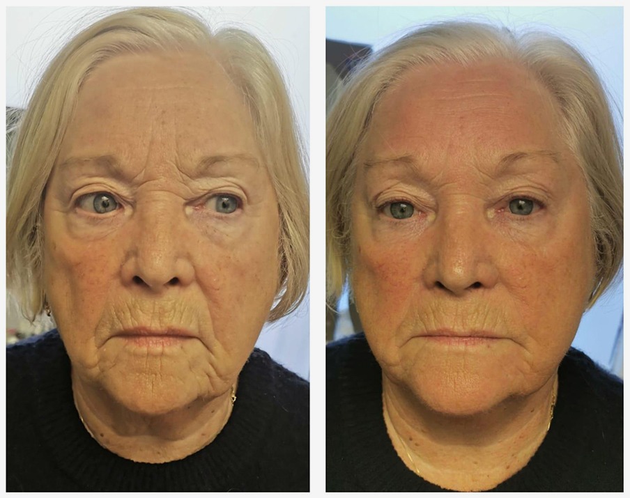 T-Shape Facial Full Face result