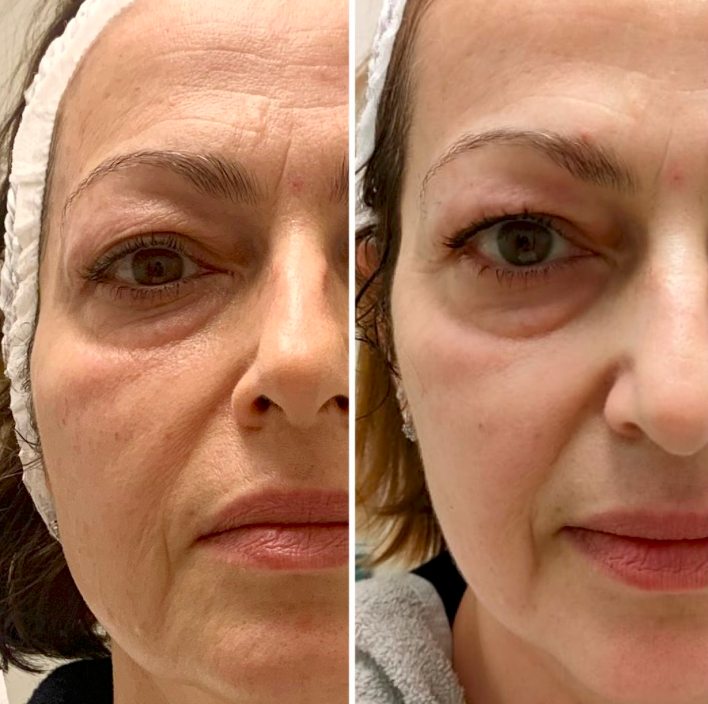 T-Shape Facial Eye & Cheek Area result
