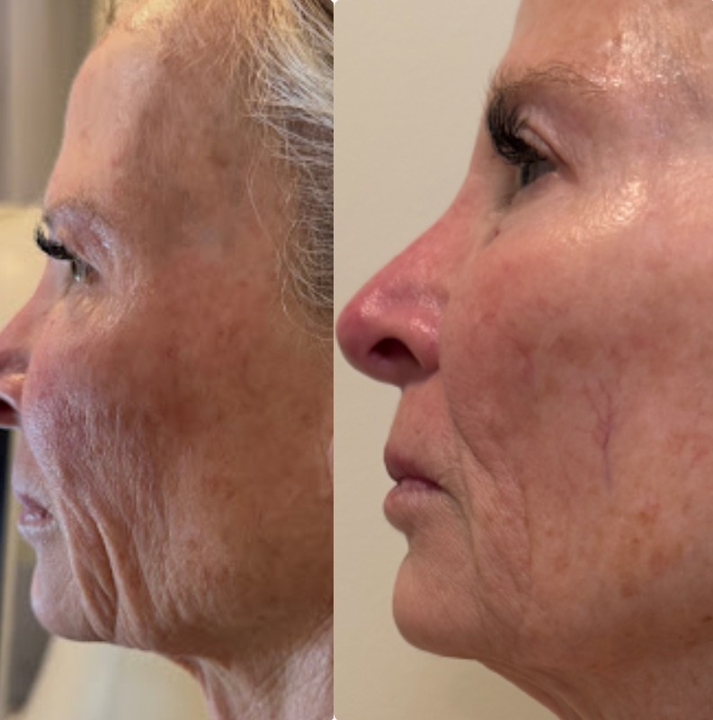 T-Shape Facial Face & Jawline result